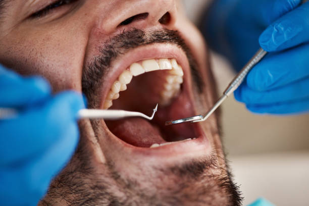 Best Emergency Wisdom Tooth Extraction in Jamestown West, NY