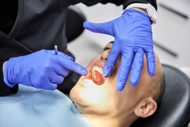 Best Knocked-Out Tooth (Avulsed Tooth) Treatment in Jamestown West, NY